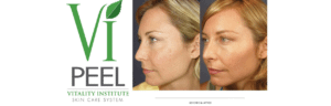 Vi Peel logo and before and after treatment images