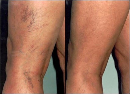 Example of before and after treatment to remove spider veins