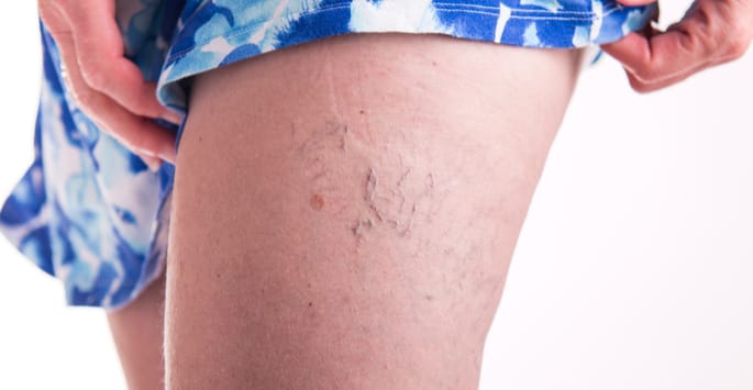 Close-up of a woman's thigh in shorts that has spider varicose veins
