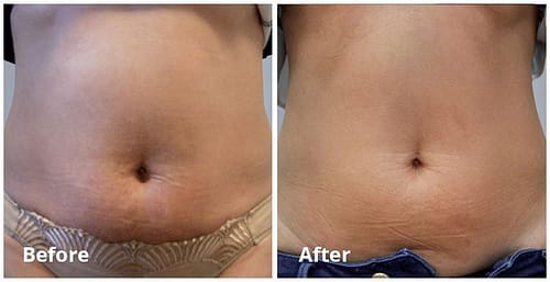 Example of before and after tummy results for a body shaping and cellulite treatment from Body FX