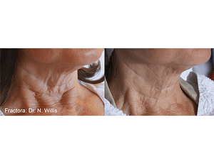 Example of before and after anti-aging neck results from a Fractora skin treatment