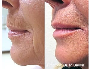Example of before and after anti-aging lipline results from a Fractora skin treatment