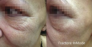 Example of before and after anti-aging cheek results from a Fractora skin treatment