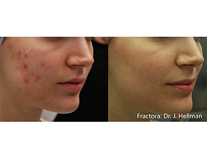 Example of before and after ance removal results from a Fractora skin treatment