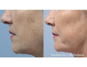 Example of before and after anti-aging cheek results from a Fractora skin treatment